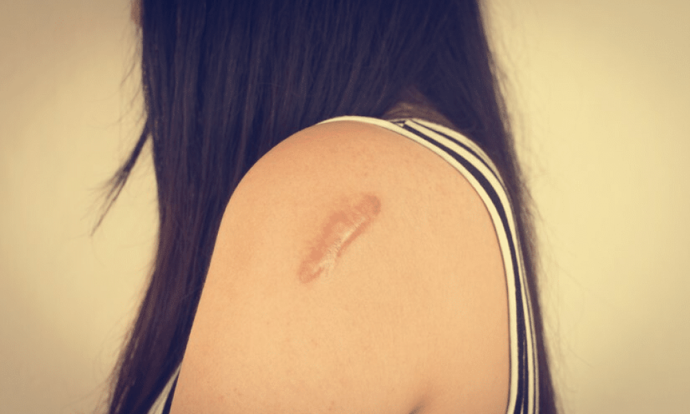 Mal-être à cause de cicatrices: que faire?