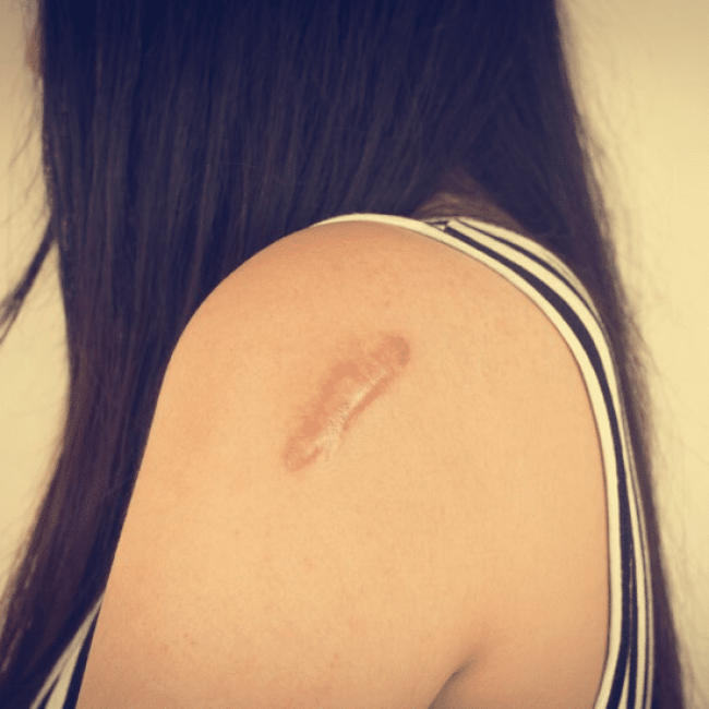 Mal-être à cause de cicatrices: que faire?